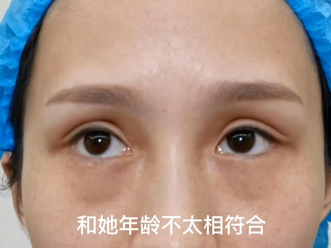 女人眼睛凹陷是克夫相