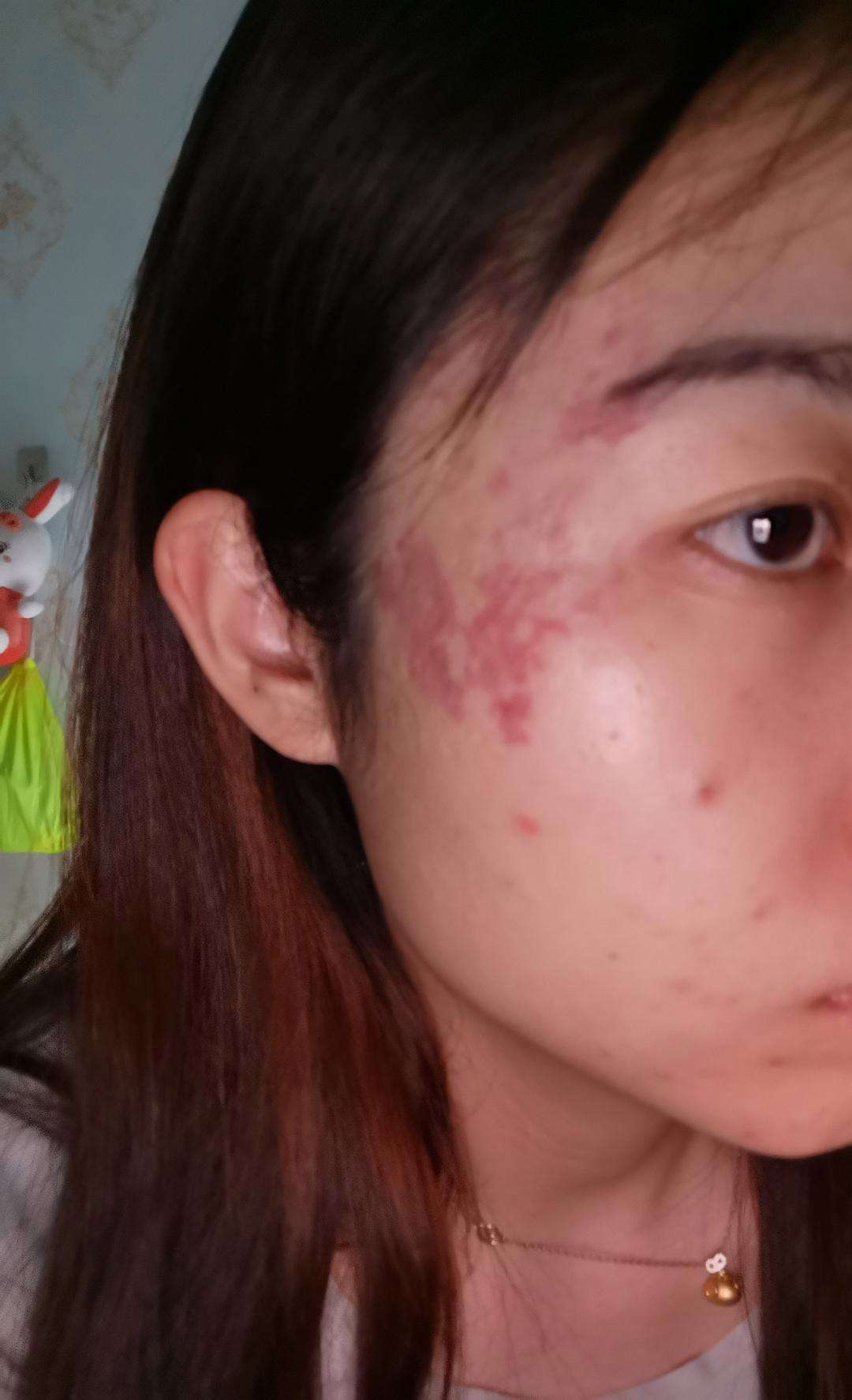 额头有胎记的女人命运好吗 额头胎记的有什么含义