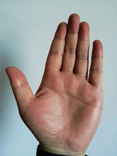 断掌纹:断掌纹到底意味着什么