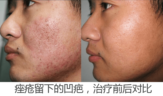 男人的伤疤:男人人中有疤面相代表了什么