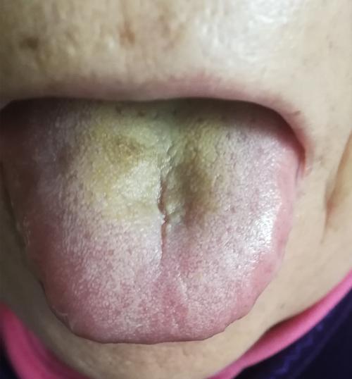 看舌苔知病情图解 看舌苔知病情图解怎么看