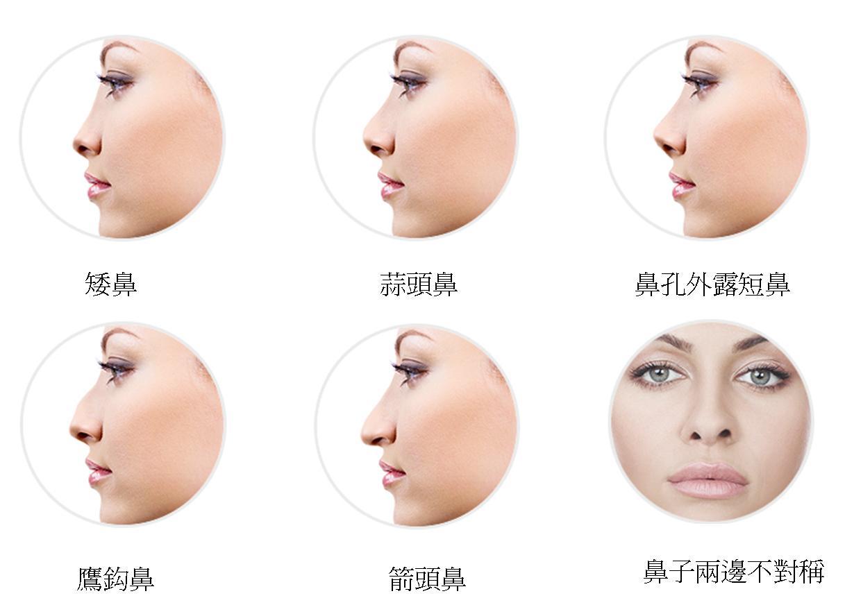 蒜头鼻图片蒜头鼻运势如何